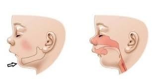 ناهنجاری فک در کودک